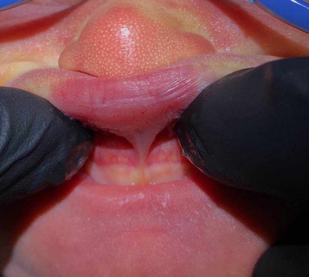 Before Lip Tie Release at Our Pediatric Dental Office in Hammond LA Before Lip Tie Release at Hammond LA Top Pediatric Dentist