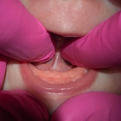 Before Tongue Tie Release Treatment at Our Pediatric Dentist in Hammond LA Before tongue tie release at pediatric dentist in Hammond LA