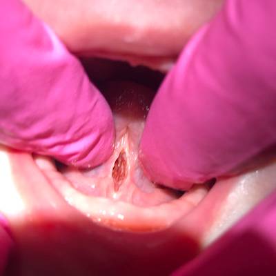 After tongue tie release at Hammond LA's top dentist for children. After tongue tie release at our pediatric dentist in Hammond LA