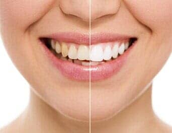 Teeth before and after — Dentist Care in Naples, FL Teeth before and after — Dentist Care in Naples, FL