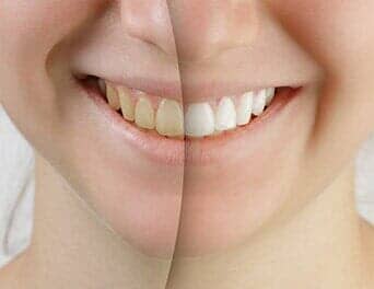 Before and after — Whitening in Naples, FL