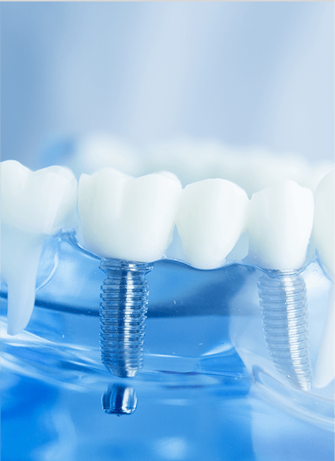 Dental implants - Park Place Dental