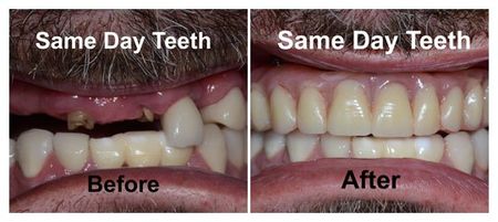 Before and After Same Day Teeth — Fort Myers, FL — Children & Adult Dentistry Before and After Same Day Teeth — Fort Myers, FL — Children & Adult Dentistry