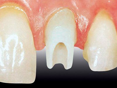 Explaining Dental Implants — Fort Myers, FL — Children & Adult Dentistry