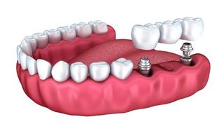 Dental Crowns and Tooth — Fort Myers, FL — Children & Adult Dentistry Dental Crowns and Tooth — Fort Myers, FL — Children & Adult Dentistry