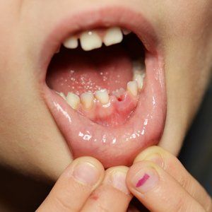 Tooth Extraction — Fort Myers, FL — Children & Adult Dentistry Tooth Extraction — Fort Myers, FL — Children & Adult Dentistry