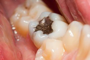 Tooth Extraction — Fort Myers, FL — Children & Adult Dentistry Tooth Extraction — Fort Myers, FL — Children & Adult Dentistry