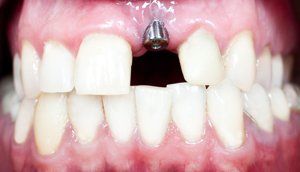 Implant Restoration — Fort Myers, FL — Children & Adult Dentistry Implant Restoration — Fort Myers, FL — Children & Adult Dentistry