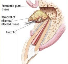 Apicoectomy1