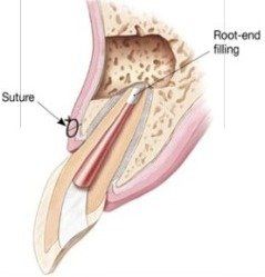 Apicoectomy2