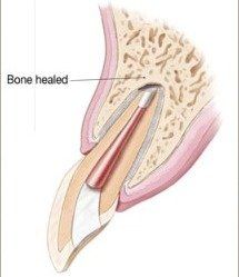 Apicoectomy3