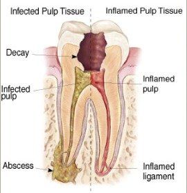 root canal