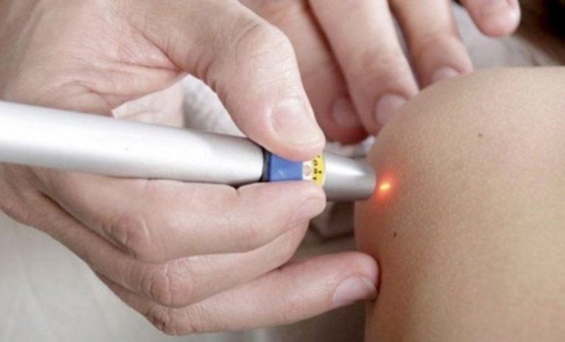 Trattamento laser cutaneo