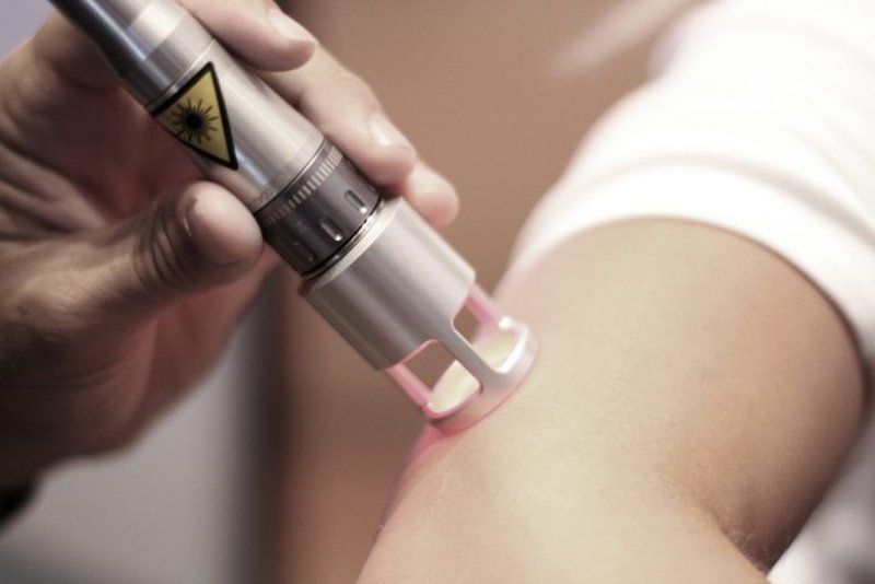 Trattamento laser