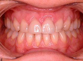 Cosmetic dentistry - 1 before