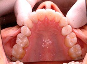 Porcelain Veneers