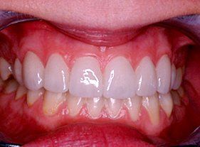 Cosmetic dentistry - 1 after