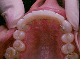 Cosmetic dentistry - 1 after