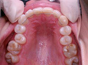 Cosmetic dentistry - 1 before