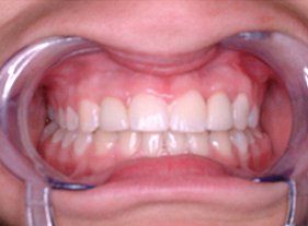 Cosmetic dentistry - 1 after