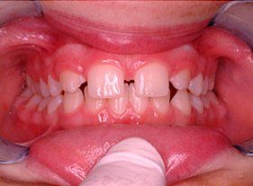 Cosmetic dentistry - 1 before