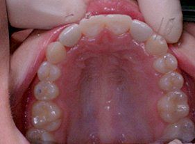 Cosmetic dentistry - 1 after