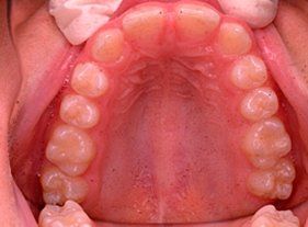 Cosmetic dentistry - 1 before