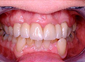 Cosmetic dentistry - 1 after
