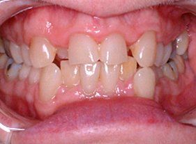 Cosmetic dentistry - 1 before