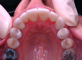 Cosmetic dentistry - 1 after
