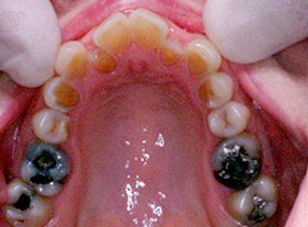 Cosmetic dentistry - 1 before