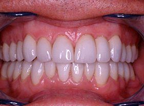 Cosmetic dentistry - 1 after