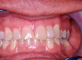 Cosmetic dentistry - 1 before