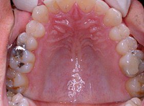 Cosmetic dentistry - 1 before