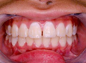 Cosmetic dentistry - 1 after