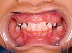 Cosmetic dentistry - 1 before