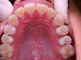 Cosmetic dentistry - 1 after