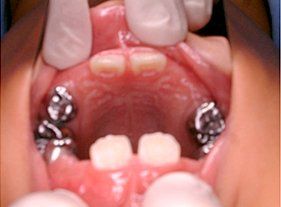 Cosmetic dentistry - 1 before