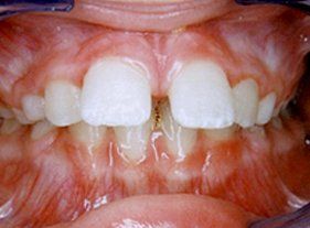 Cosmetic dentistry - 1 before