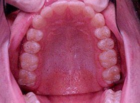 Cosmetic dentistry - 1 after