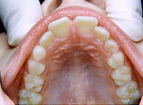 Cosmetic dentistry - 1 before