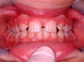 Cosmetic dentistry - 1 before