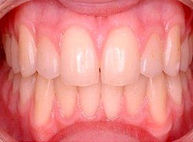 Cosmetic dentistry - 1 after