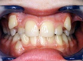Cosmetic dentistry - 1 before