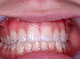 Cosmetic dentistry - 1 after