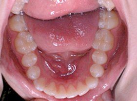 Cosmetic dentistry - 1 after