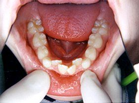 Cosmetic dentistry - 1 before