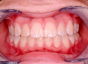 Cosmetic dentistry - 1 after