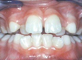 Cosmetic dentistry - 1 before