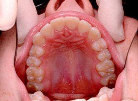 Cosmetic dentistry - 1 before